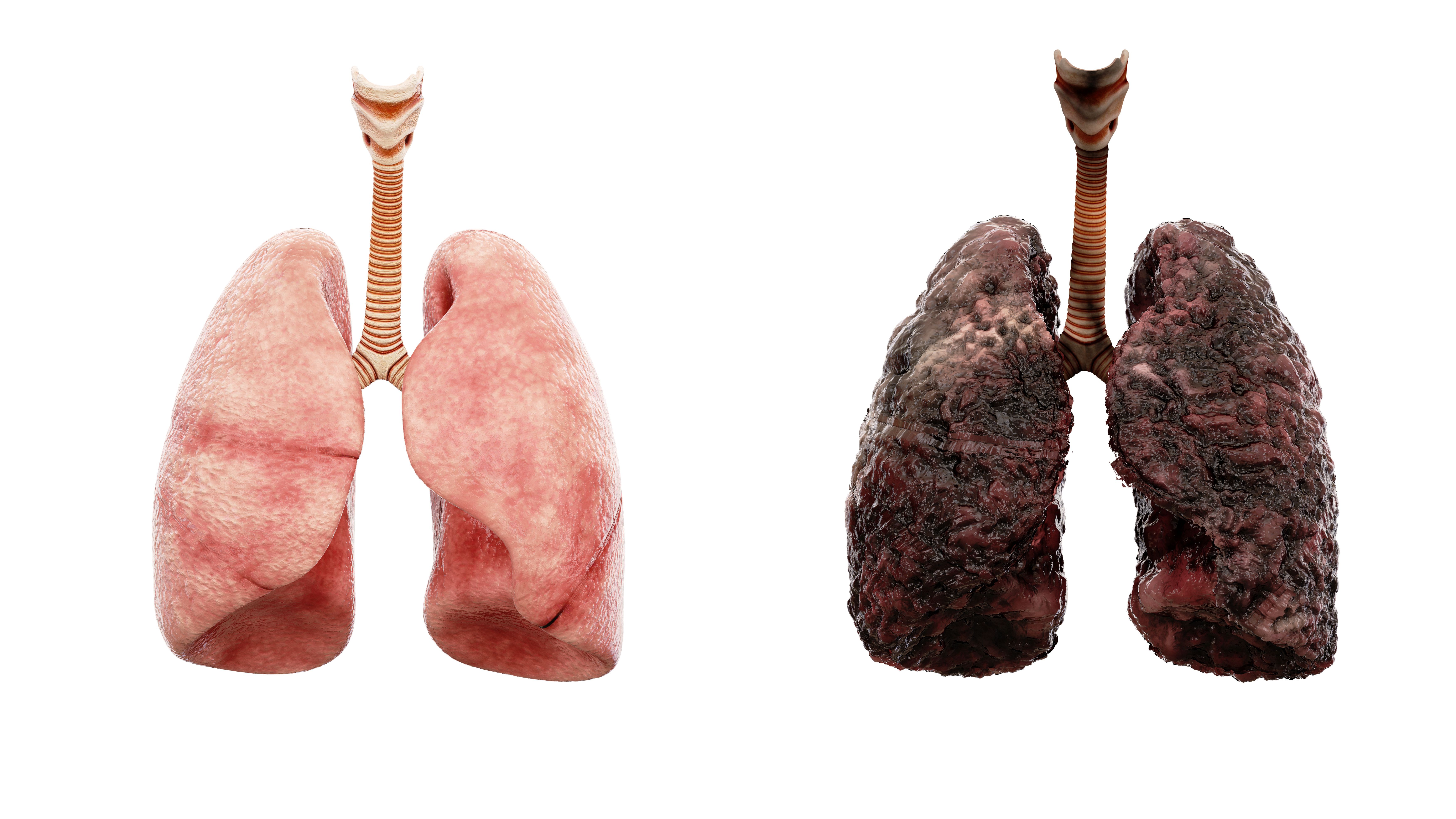 Lung Cancer Diagnosis, Surgery and Chemotherapy
