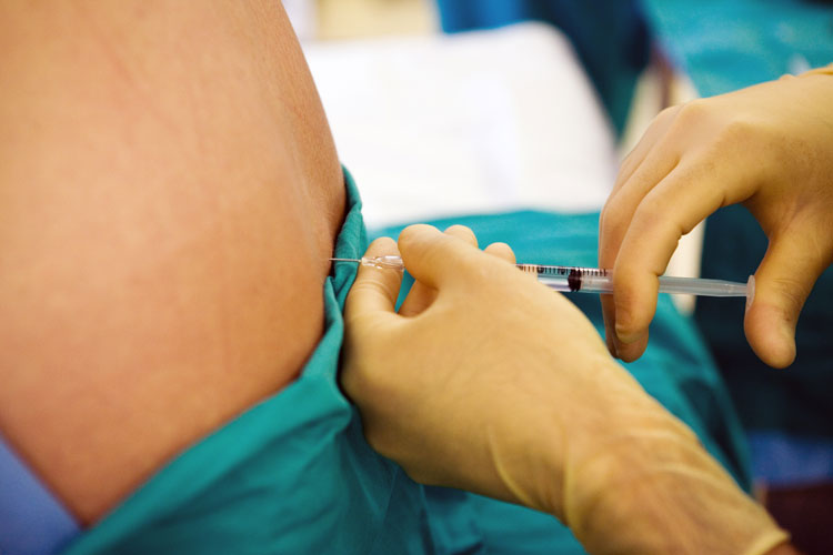 Painless Delivery — Epidural Analgesia in Labour